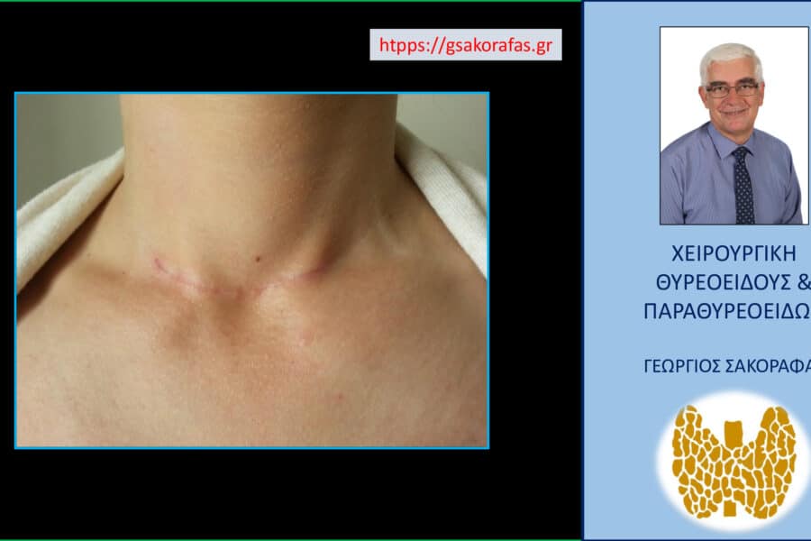 Θυρεοειδεκτομή και χηλοειδές: Πρόληψη και φροντίδα της ουλής στον τράχηλο