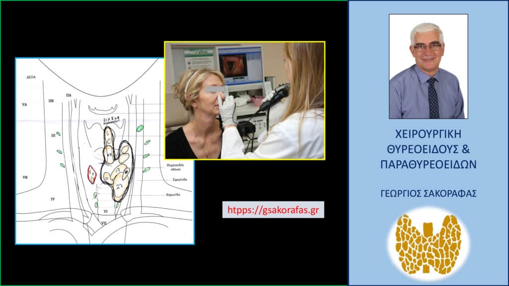 Θυρεοειδεκτομή και λαρυγγοσκόπηση προεγχειρητικά– με αφορμή ασθενή μας Θυρεοειδεκτομή και λαρυγγοσκόπηση προεγχειρητικά– με αφορμή ασθενή μας. Κάτω αριστερά σχηματικά τα ευρήματα (υποτροπή οζώδους θυρεοειδοπάθειας).