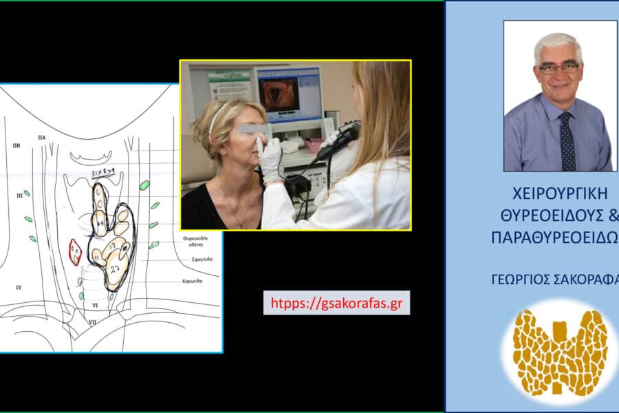 Θυρεοειδεκτομή και λαρυγγοσκόπηση προεγχειρητικά– με αφορμή ασθενή μας. Κάτω αριστερά σχηματικά τα ευρήματα (υποτροπή οζώδους θυρεοειδοπάθειας).