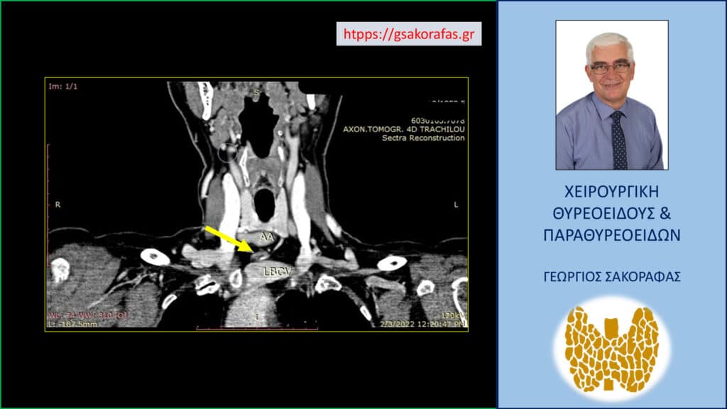 Αδένωμα παραθυρεοειδούς σε έκτοπη θέση σε ασθενή μας με πρωτοπαθή υπερπαραθυρεοειδισμό – ακριβής εντοπισμός με τετραδιάστατη αξονική τομογραφία, αρνητικό υπερηχογράφημα και +/- σπινθηρογράφημα Αδένωμα παραθυρεοειδούς σε έκτοπη θέση (κίτρινο βέλος) – Εικόνα στην τετραδιάστατη αξονική τομογραφία σε εγκάρσια διατομή: το αδένωμα εντοπίσθηκε μεταξύ ανωνύμου αρτηρίας (ΑΑ) και βραχιονοκεφαλικής φλέβας (LBCV).