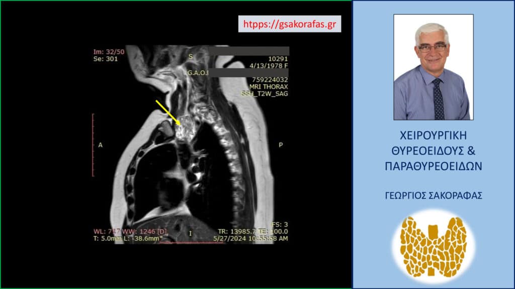 Καταδυόμενη βρογχοκήλη, σε βάθος μέχρι το ύψος του αορτικού τόξου – αφαίρεση μέσω τραχηλικής τομής Καταδυόμενη βρογχοκήλη (κίτρινο βέλος)– απεικόνιση στην μαγνητική τομογραφία σε προσθιοπίσθια διατομή. Και στην τομή αυτή καθίσταται εμφανές το βάθος κατάδυσης στο μεσοθωράκιο.