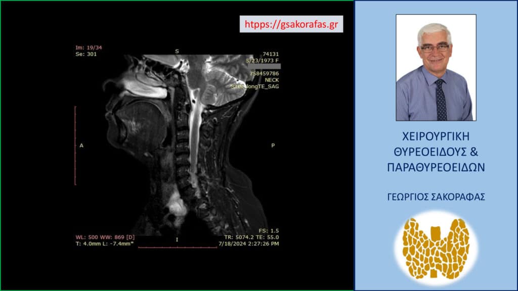 Αδένωμα παραθυρεοειδούς - ευρηματα στην μαγνητική τομογραφία (προσθιοπίσθια διατομή)