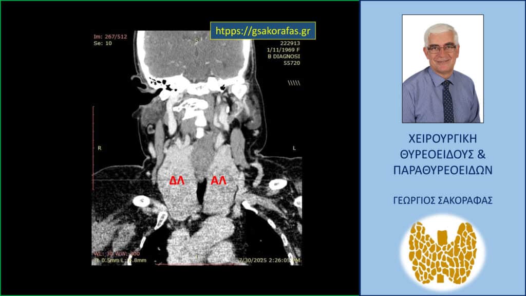 Καταδυόμενη βρογχοκήλη, γιγάντια, σε ασθενή με εξαιρετικά ‘δύσκολο’ τράχηλο – ολική θυρεοειδεκτομή μέσω τραχηλικής τομής. Καταδυόμενη βρογχοκήλη, γιγάντια, σε ασθενή με εξαιρετικά ‘δύσκολο’ τράχηλο. Απεικόνιση στην αξονική τομογραφία – εγκάρσια διατομή. Εμφανής η μεγάλου βαθμού διόγκωση και των δύο λοβών του θυρεοειδούς αδένα (γιγάντια βρογχοκήλη) με κατάδυση αυτών στο μεσοθωράκιο. Ο αριστερός λοβός (Α.Λ.) εκτείνεται σε βάθος στο μεσοθωράκιο μέχρι τις παρυφές του αορτικού τόξου.