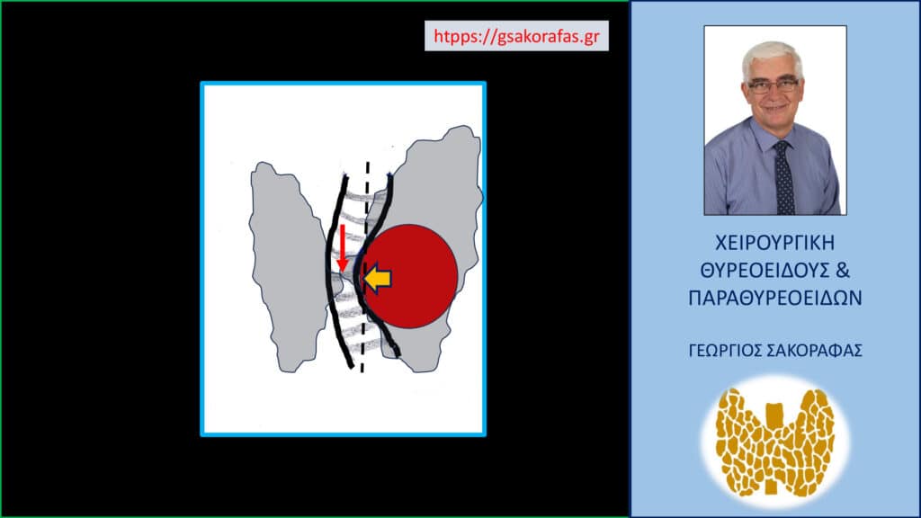 Βρογχοκήλη – όζοι θυρεοειδούς και πιεστικά φαινόμενα από την τραχεία Βρογχοκήλη – όζοι θυρεοειδούς και πιεστικά φαινόμενα από την τραχεία. Σενάριο 1