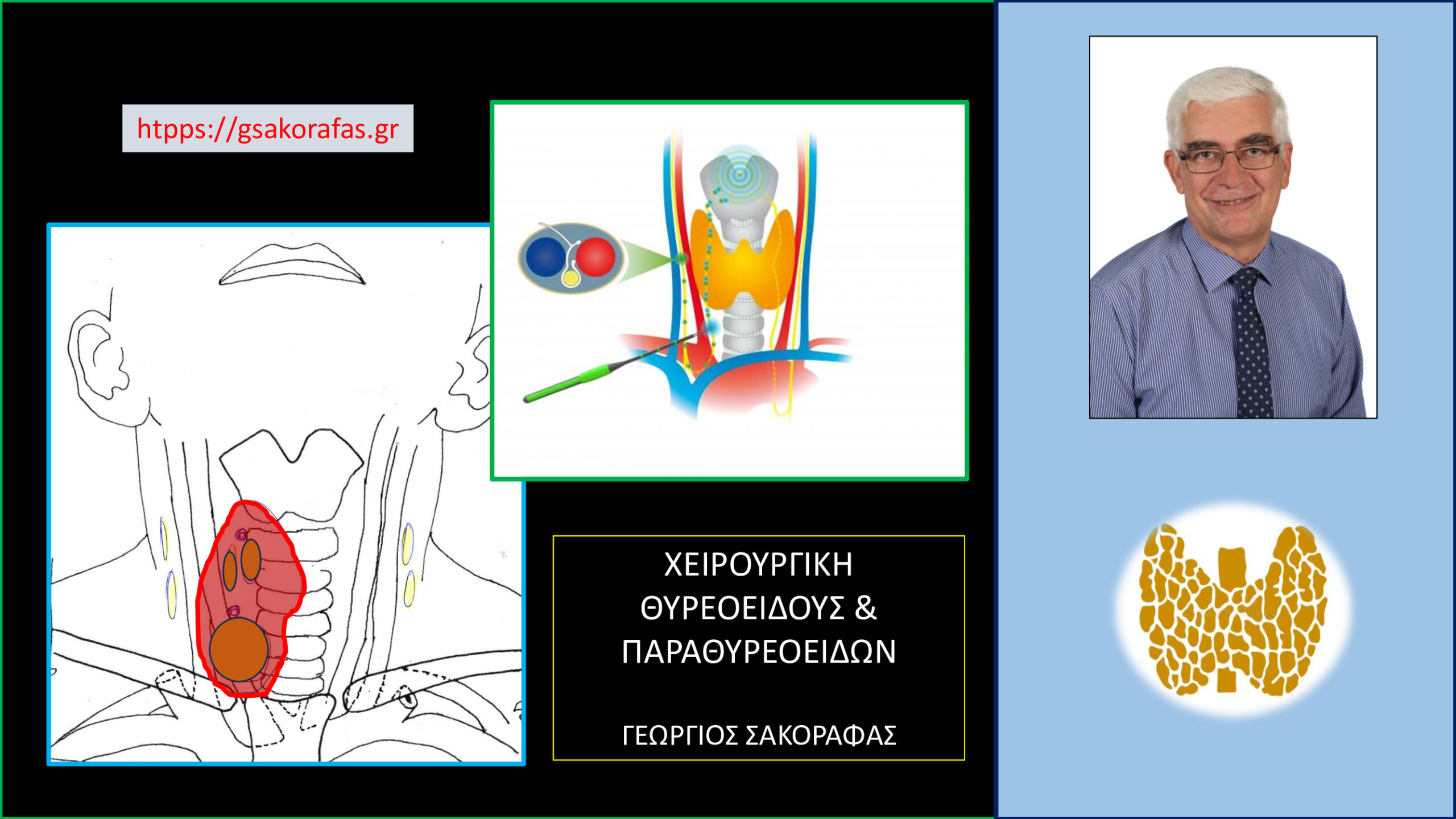 Καρκίνος θυρεοειδούς  και διεγχειρητική νευροπαρακολούθηση – κάποιες σκέψεις με αφορμή ασθενή μας.