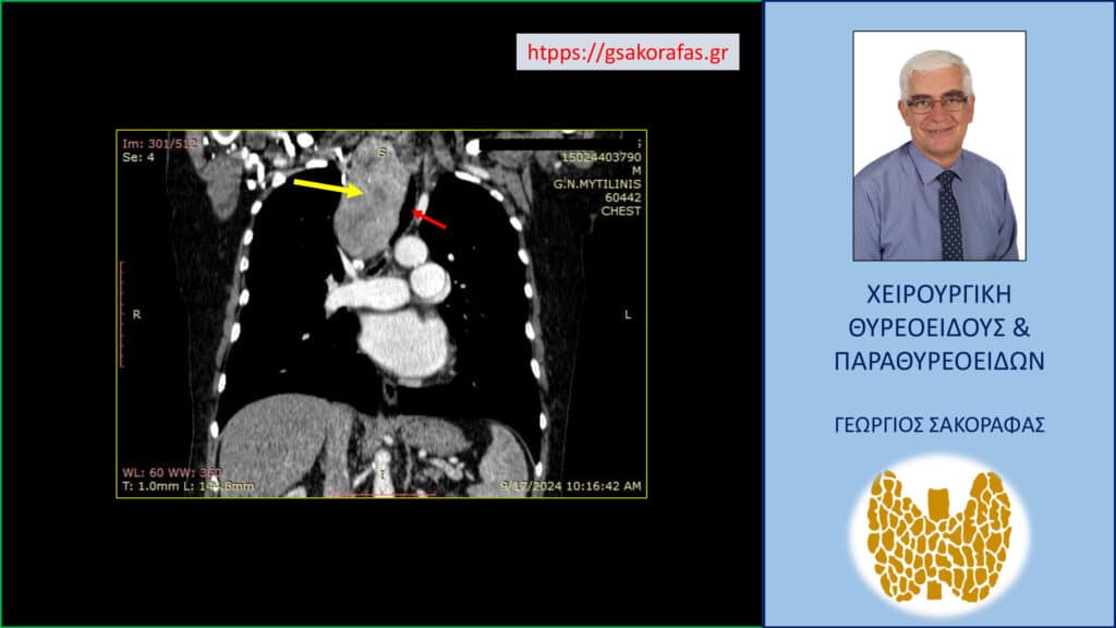 Home Καταδυόμενη βρογχοκήλη – απεικόνιση στην αξονική τομογραφία σε κατά μέτωπο διατομή. Εμφανής η πολύ μεγάλου βαθμού διόγκωση του δεξιού λοβού του θυρεοειδούς (κίτρινο βέλος) και η κατάδυσή του σε μεγάλο βάθος στην κοιλότητα του θώρακα, περίπου μέχρι τη μεσότητά του, στο ύψος του διχασμού της τραχείας (κόκκινο βέλος).