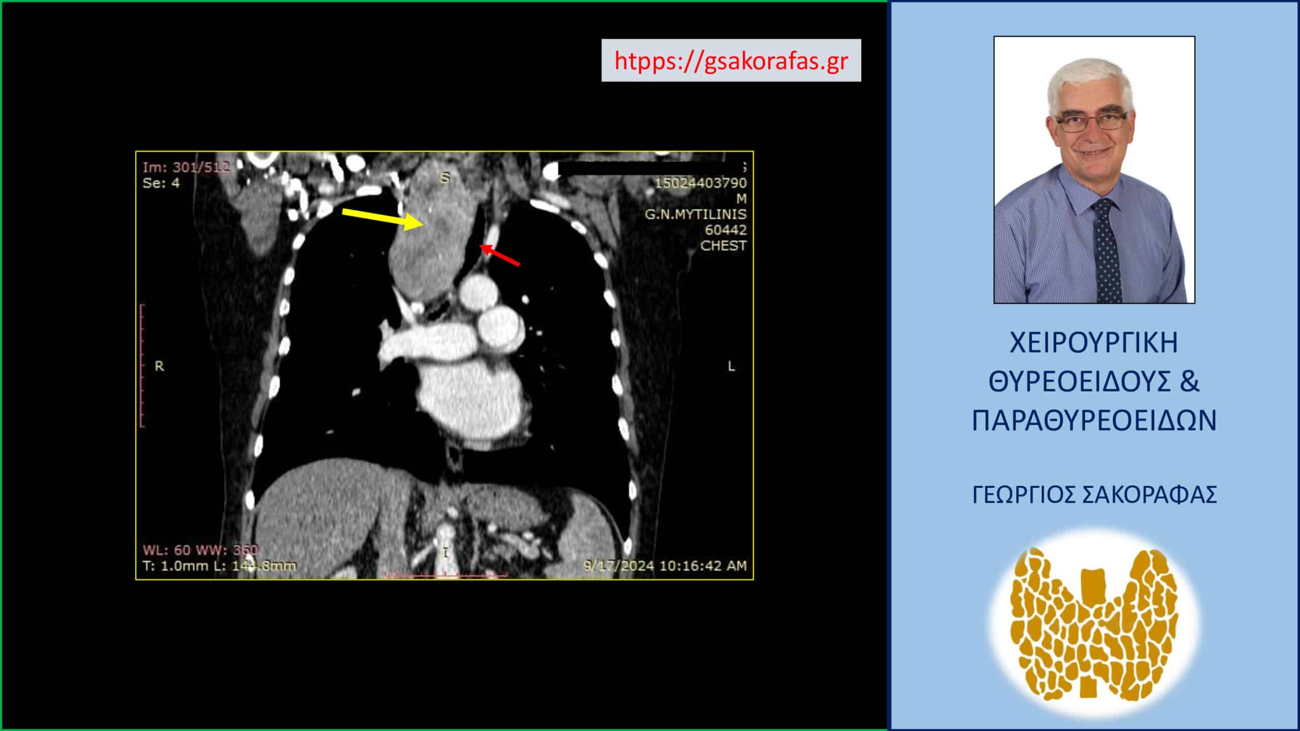 Καταδυόμενη βρογχοκήλη με εξαιρετικά μεγάλο βάθος κατάδυσης στο θώρακα σε υπερήλικα ασθενή – αφαίρεση μέσω της τραχηλικής τομής (Εικόνες)