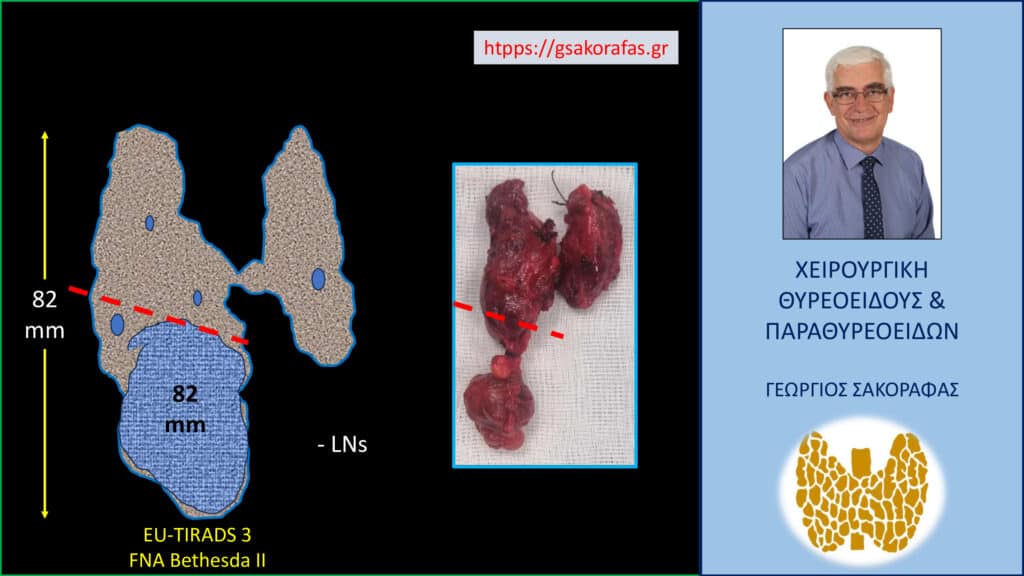 Home Όζος θυρεοειδούς εξωφυτικός καταδυόμενος – με αφορμή ασθενή μας
