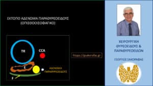 Αδένωμα παραθυρεοειδούς σε έκτοπη (οπισθοοισοφαγική) θέση. Σχηματική αναπαράσταση των ευρημάτων του υπερηχογραφήματος. TR=Τραχεία, Ε=οισοφάγος, CCA=κοινή καρωτίδα, F=προσπονδυλική περιτονία.