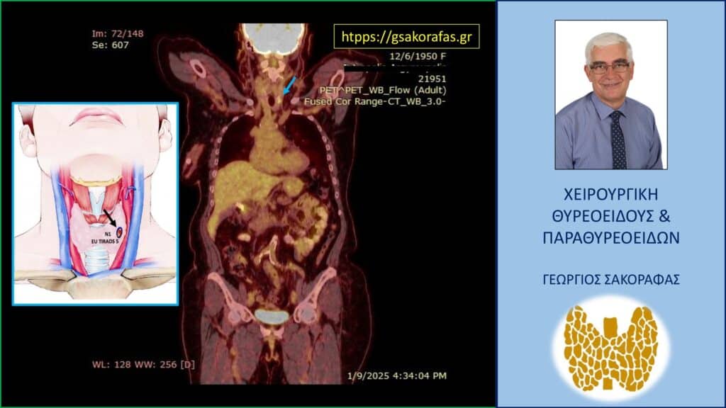Home Καρκίνος θυρεοειδούς – ‘τυχαίωμα’ σε PET-CT scan. Δεξιά η απεικόνιση της ύποπτης βλάβης στο PET-CT scan. Αριστερά στο ένθετο η ίδια βλάβη απεικονίσθηκε στο υπερηχογράφημα με ύποπτη ηχομορφολογία.