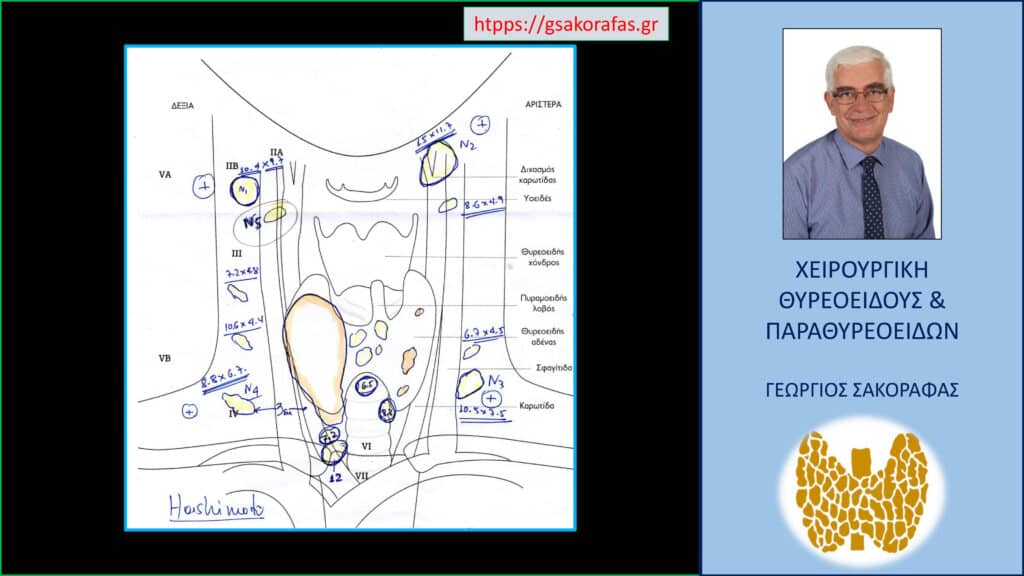 Home Καρκίνος θυρεοειδούς, τοπικά προχωρημένος, με αμφοτερόπλευρη λεμφαδενική διασπορά σε ασθενή με εξαιρετικά δύσκολο σωματότυπο. Τα ευρήματα του προεγχειρητικού ελέγχου – χαρτογράφησης λεμφαδένων με τις δικές μας σημειώσεις όπου συνοψίζονται όλα τα δεδομένα (και της παρακέντησης με λεπτή βελόνη). Σημειώνεται το μεγάλο μέγεθος του καρκίνου και η παρουσία διηθημένων λεμφαδένων στα τέσσερα «άκρα» του «δύσκολου τραχήλου» (πάνω δεξιά – πάνω αριστερά – κάτω δεξιά – κάτω αριστερά).