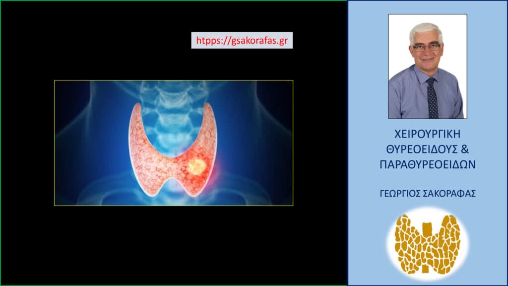 Home Καρκίνος θυρεοειδούς και πρόγνωση – από τι εξαρτάται?