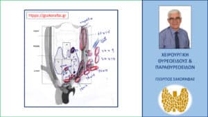 Υπερηχογράφημα με χαρτογράφηση λεμφαδένων τραχήλου – σχηματική αναπαράσταση των ευρημάτων. Απεικονίζεται η εκτεταμένη λεμφαδενική διασπορά στους λεμφαδένες της αριστερής πλάγιας τραχηλικής χώρας, που πρακτικά καταλαμβάνεται εξ ολοκλήρου από τους παθολογικούς λεμφαδένες. Εντυπωσιακό – πέραν του αριθμού – είναι και το μέγεθος των διηθημένων λεμφαδένων.
