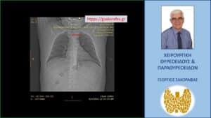 Αξονική τομογραφία – τοπόγραμμα. Εμφανής η απώθηση - απόκλιση της τραχείας (κόκκινο βέλος) προς τα δεξιά λόγω πίεσής της από τον διογκωμένο καταδυόμενο αριστερό λοβό.