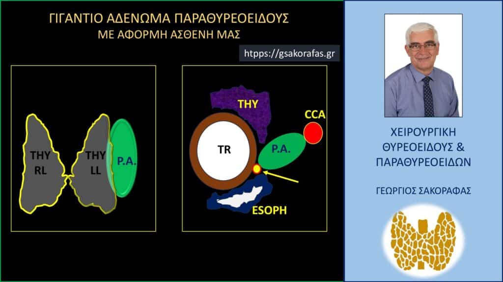 Home Γιγάντιο αδένωμα παραθυρεοειδούς – με αφορμή ασθενή μας