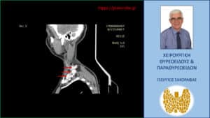 Αξονική τομογραφία – διατομή σε προσθιοπίσθιο επίπεδο. Εμφανείς οι ευμεγέθεις λεμφαδενικές μεταστάσεις, κάποιες από τις οποίες επισημαίνονται με τα κόκκινα βέλη.