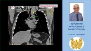 Αξονική τομογραφία – απεικόνιση σε κατά μέτωπο διατομή. Εμφανής η μεγάλου βαθμού διόγκωση και η κατάδυση σε βάθος του αριστερού λοβού (κίτρινο βέλος), που φθάνει στις παρυφές του αορτικού τόξου (πράσινο βέλος), με την τραχεία (κόκκινο βέλος) να απωθείται προς τα δεξιά από τον διογκωμένο αριστερό λοβό.