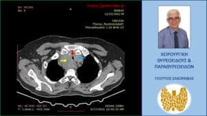 Αξονική τομογραφία – εγκάρσια διατομή. Ο λίαν διογκωμένος και καταδυόμενος δεξιός λοβός (κίτρινο βέλος) απωθεί προς τα αριστερά την τραχεία (κόκκινο βέλος), που συμπιέζεται και από τον λιγότερο διογκωμένο αριστερό λοβό (μπλε βέλος), με αποτέλεσμα την στένωση του αυλού της