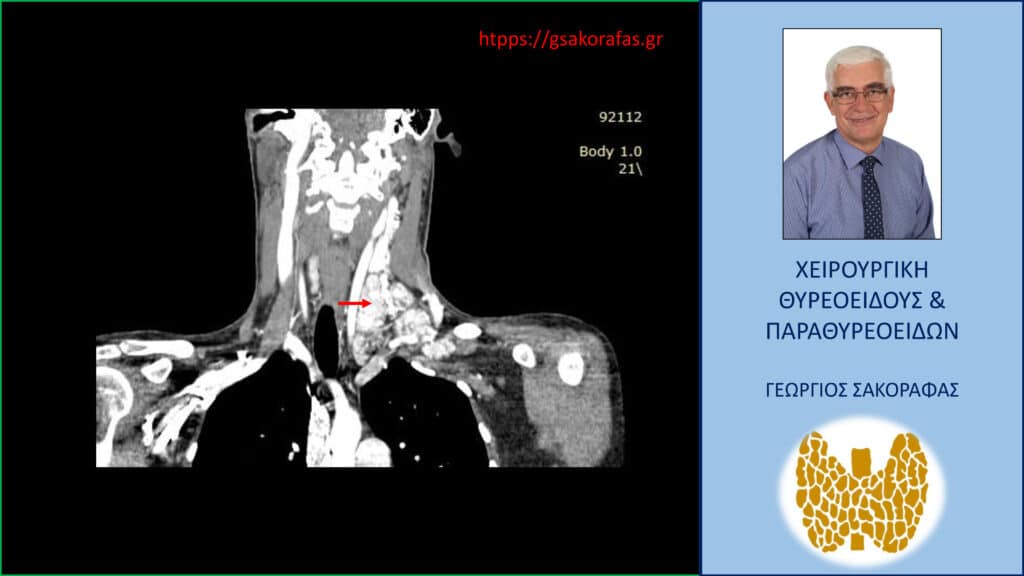 Home Καρκίνος θυρεοειδούς με εκτεταμένη λεμφαδενική διασπορά - Αξονική τομογραφία – απεικόνιση σε κατά μέτωπο διατομή. Απεικονίζεται η εκτεταμένη λεμφαδενική διασπορά στους λεμφαδένες της αριστερής πλάγιας τραχηλικής χώρας. Το κόκκινο βέλος έχει τοποθετηθεί περίπου στο κέντρο της εκτεταμένης λεμφαδενικής διασποράς, που εκτείνεται σε μεγάλη έκταση επί τα εκτός των μεγάλων αγγείων του τραχήλου.