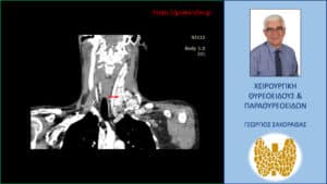 Καρκίνος θυρεοειδούς με εκτεταμένη λεμφαδενική διασπορά - Αξονική τομογραφία – απεικόνιση σε κατά μέτωπο διατομή. Απεικονίζεται η εκτεταμένη λεμφαδενική διασπορά στους λεμφαδένες της αριστερής πλάγιας τραχηλικής χώρας. Το κόκκινο βέλος έχει τοποθετηθεί περίπου στο κέντρο της εκτεταμένης λεμφαδενικής διασποράς, που εκτείνεται σε μεγάλη έκταση επί τα εκτός των μεγάλων αγγείων του τραχήλου.