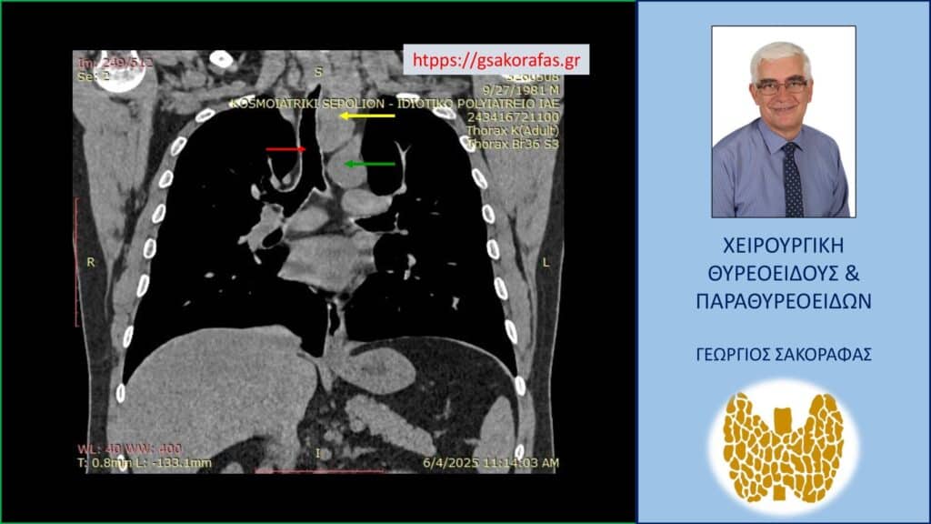 Home Καταδυόμενη βρογχοκήλη με κατάδυση σε βάθος στο θώρακα – εικόνα στην αξονική τομογραφία (κατά μέτωπο διατομή, σε άλλο επίπεδο). Εμφανής η μεγάλου βαθμού διόγκωση και η κατάδυση σε βάθος του αριστερού λοβού (κίτρινο βέλος), που φθάνει στις παρυφές του αορτικού τόξου (πράσινο βέλος), με την τραχεία (κόκκινο βέλος) να απωθείται προς τα δεξιά από τον διογκωμένο αριστερό λοβό. Ο καταδυόμενος αριστερός λοβός φθάνει σε βάθος λίγο πιο πάνω από τον διχασμό της τραχείας στους δύο στελεχιαίους βρόγχους.