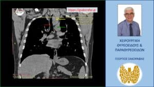 Καταδυόμενη βρογχοκήλη με κατάδυση σε βάθος στο θώρακα – εικόνα στην αξονική τομογραφία (κατά μέτωπο διατομή, σε άλλο επίπεδο). Εμφανής η μεγάλου βαθμού διόγκωση και η κατάδυση σε βάθος του αριστερού λοβού (κίτρινο βέλος), που φθάνει στις παρυφές του αορτικού τόξου (πράσινο βέλος), με την τραχεία (κόκκινο βέλος) να απωθείται προς τα δεξιά από τον διογκωμένο αριστερό λοβό. Ο καταδυόμενος αριστερός λοβός φθάνει σε βάθος λίγο πιο πάνω από τον διχασμό της τραχείας στους δύο στελεχιαίους βρόγχους.