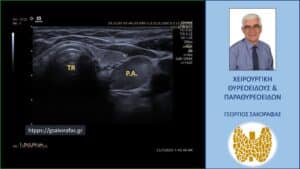 Απεικόνιση του αδενώματος στο υπερηχογράφημα - εγκάρσια διατομή