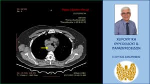 Αξονική τομογραφία – εγκάρσια διατομή σε χαμηλότερο επίπεδο, όπου φαίνεται η βαθιά κατάδυση του δεξιού λοβού στο μεσοθωράκιο