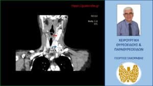 Ανάλογη με την προηγούμενη απεικόνιση αλλά σε άλλο επίπεδο στην αξονική τομογραφία. Εμφανής (κόκκινο βέλος) ο πλέον ευμεγέθης παθολογικός λεμφαδένας ψηλά στον τράχηλο (επίπεδο ΙΙ), με το άνω όριό του να είναι σε επαφή με τον αριστερό υπογνάθιο σιελογόνο αδένα. Το μπλε βέλος έχει τοποθετηθεί σε χαμηλότερο επίπεδο εκεί όπου βρίσκεται το ‘συνονθύλευμα’ των πολλαπλών ευμεγέθων παθολογικών λεμφαδένων.