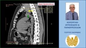 Αξονική τομογραφία – εικόνα σε διατομή κατά το προσθιοπίσθιο επίπεδο. Και στη διατομή αυτή φαίνεται η βαθιά κατάδυση του αριστερού λοβού (κίτρινο βέλος), που φθάνει στο άνω όριο του αορτικού τόξου (πράσινο βέλος).