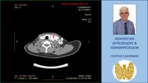 Αξονική τομογραφία – απεικόνιση σε εγκάρσια διατομή. Το βέλος έχει τοποθετηθεί στην περιοχή όπου εντοπίζονται οι παθολογικοί τραχηλικοί λεμφαδένες (ευρίσκονται εκατέρωθεν του βέλους, που έχει τοποθετηθεί ενδεικτικά).