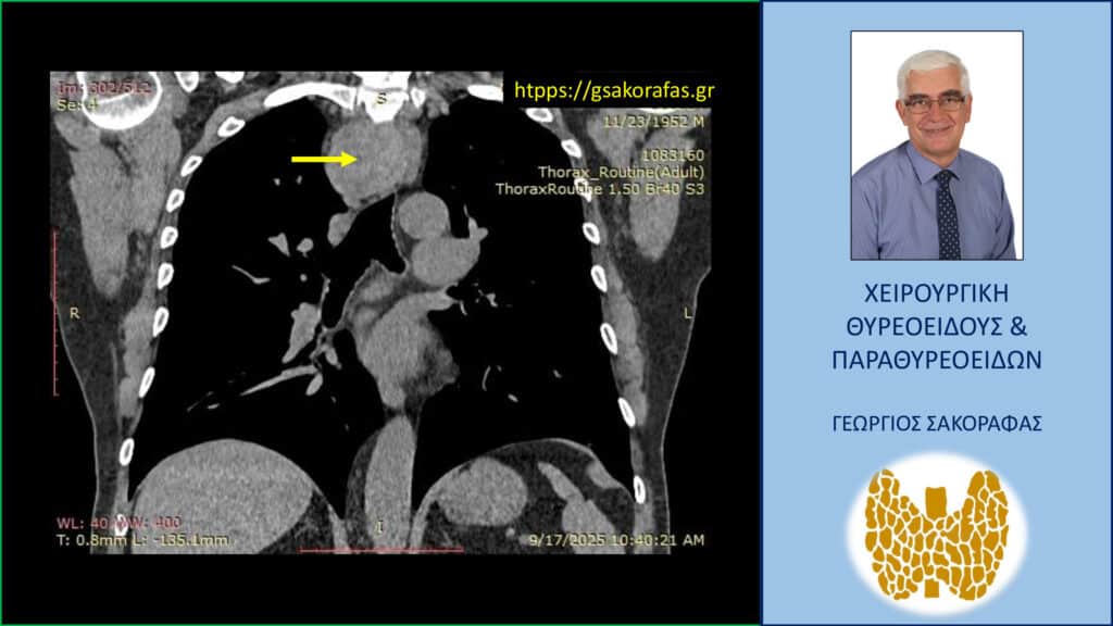 Home Καταδυόμενη βρογχοκήλη. Αξονική τομογραφία – κατά μέτωπο διατομή. Εμφανής η σε βάθος κατάδυση του δεξιού λοβού στο μεσοθωράκιο (κίτρινο βέλος) που φθάνει σχεδόν στο ύψος του διχασμού της τραχείας, που απωθείται προς τα αριστερά.