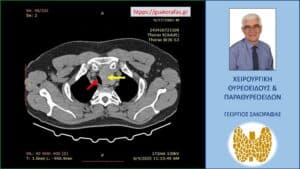 Αξονική τομογραφία – εγκάρσια διατομή. Ο διογκωμένος αριστερός λοβός (κίτρινο βέλος) που απωθεί την τραχεία (κόκκινο βέλος) προς τα δεξιά.