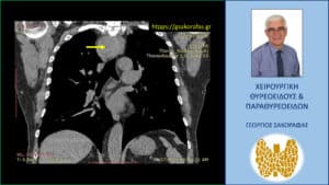 Καταδυόμενη βρογχοκήλη. Αξονική τομογραφία – κατά μέτωπο διατομή. Εμφανής η σε βάθος κατάδυση του δεξιού λοβού στο μεσοθωράκιο (κίτρινο βέλος) που φθάνει σχεδόν στο ύψος του διχασμού της τραχείας, που απωθείται προς τα αριστερά.