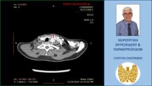 Ανάλογη με την προηγούμενη απεικόνιση στην αξονική τομογραφία, σε διαφορετικό επίπεδο εγκάρσιας διατομής.
