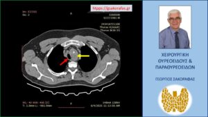 Αξονική τομογραφία – εγκάρσια διατομή σε χαμηλότερο επίπεδο. Ο διογκωμένος αριστερός λοβός (κίτρινο βέλος) που απωθεί την τραχεία (κόκκινο βέλος) προς τα δεξιά.