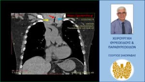 Αξονική τομογραφία – κατά μέτωπο διατομή σε άλλο επίπεδο. Απεικονίζεται η σημαντικού βαθμού στένωση της τραχείας (κόκκινο βέλος) από τον λίαν διογκωμένο δεξιό λοβό (κίτρινο βέλος) και τον διογκωμένο αριστερό λοβό (μπλε βέλος)