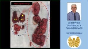 Χειρουργικό παρασκεύασμα. Δ.Λ.=δεξιός λοβός θυρεοειδούς, Α.Λ.=αριστερός λοβός θυρεοειδούς. Με το κίτρινο χρώμα επισημαίνεται η θέση της πρωτοπαθούς εστίας (17 χιλ.). Κάτωθεν του θυρεοειδούς, μέσα στο περίγραμμα με την μπλε διακεκομμένη γραμμή είναι το παρασκεύασμα του κεντρικού λεμφαδενικού καθαρισμού. Μέσα στο περίγραμμα με την κόκκινη διακεκομμένη γραμμή περιλαμβάνεται το παρασκεύασμα του αριστερού πλάγιου λεμφαδενικού καθαρισμού, μέσα στο οποίο ευρίσκονται οι περισσότεροι και μεγαλύτεροι παθολογικοί (διηθημένοι) λεμφαδένες.