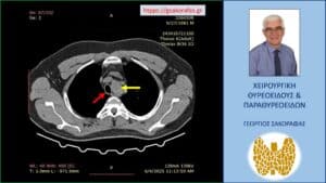 Αξονική τομογραφία – εγκάρσια διατομή σε ακόμη χαμηλότερο επίπεδο. Ο διογκωμένος αριστερός λοβός (κίτρινο βέλος) που απωθεί την τραχεία (κόκκινο βέλος) προς τα δεξιά.