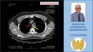 Αξονική τομογραφία – εγκάρσια διατομή σε ακόμη πιο χαμηλό επίπεδο. Ο διογκωμένος αριστερός λοβός (κίτρινο βέλος) που απωθεί την τραχεία (κόκκινο βέλος) προς τα δεξιά.
