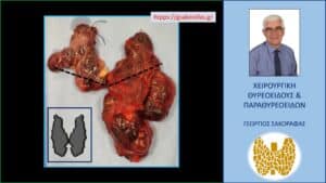 Χειρουργικό παρασκεύασμα. Στο ένθετο της εικόνας (κάτω αριστερά) είναι σχεδιασμένος υπό κλίμακα ένας θυρεοειδής φυσιολογικών διαστάσεων για λόγους σύγκρισης του μεγέθους. Εμφανής η διόγκωση του θυρεοειδούς του ασθενούς και ιδιαίτερα του αριστερού λοβού. Με τις διακεκομμένες μαύρες γραμμές απεικονίζεται σχηματικά η θέση των δύο κλειδών. Το μέρος του θυρεοειδούς που βρίσκεται κάτωθεν των γραμμών αυτών αντιστοιχεί στο καταδυόμενό του μέρος.