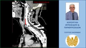 Έκτοπο αδένωμα παραθυρεοειδούς (κόκκινο βέλος)- απεικόνιση στην 4D-CT (προσθιοπίσθια διατομή). Το αδένωμα βρίσκεται σε επαφή με την προσπονδυλική περιοτονία (μαύρο βέλος)