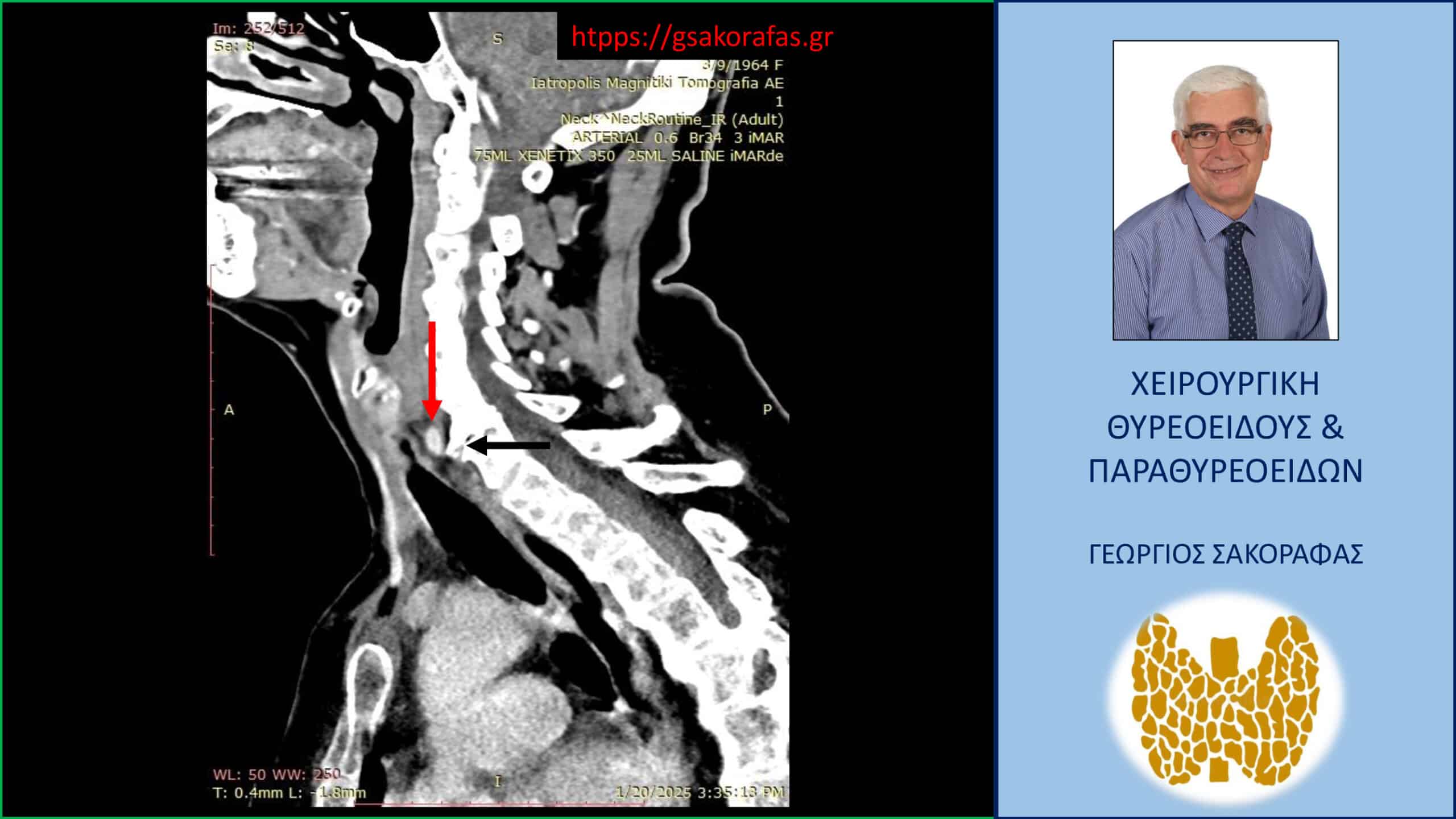 Έκτοπο αδένωμα παραθυρεοειδούς – επιμένων υπερπαραθυρεοειδισμός: με αφορμή ασθενή μας