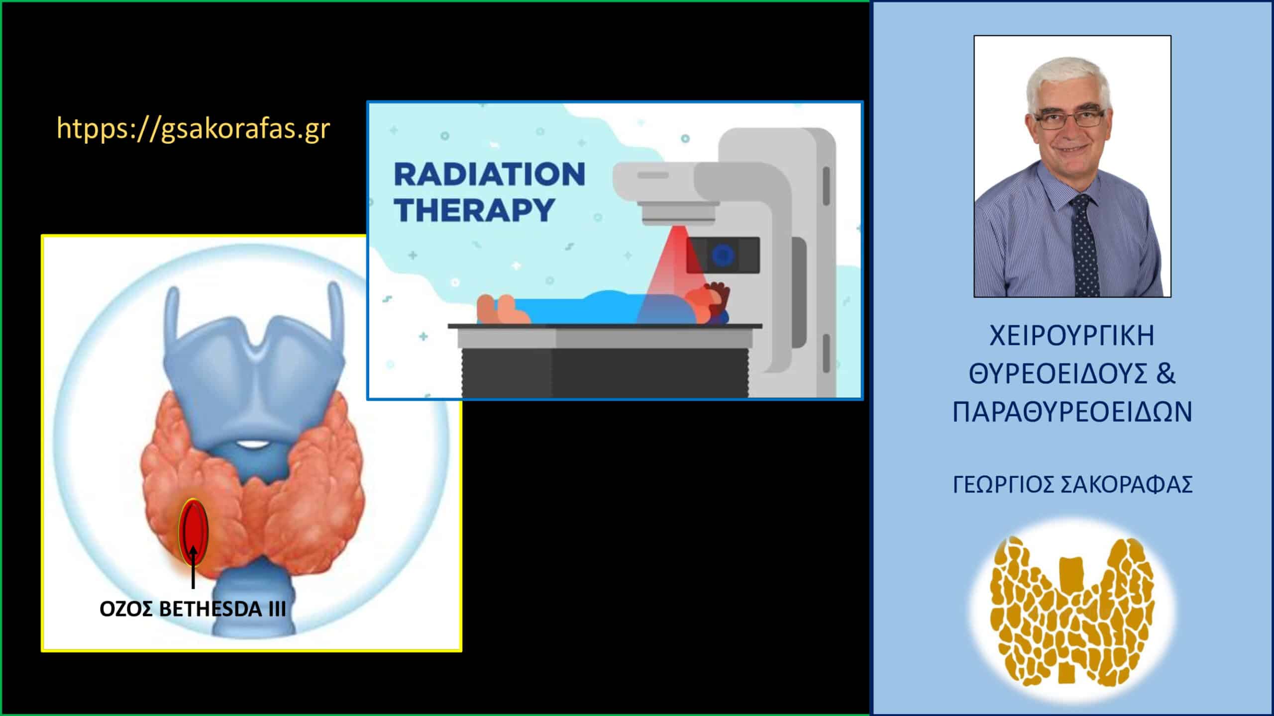 Καρκίνος θυρεοειδούς σε ασθενή με όζο Bethesda III και ιστορικό ακτινοβολίας κεφαλής – τραχήλου για καρκίνο υπερώας