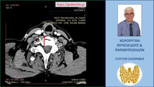 Το αδένωμα παραθυρεοειδούς (κόκκινο βέλος) - εγκάρσια διατομή 4D-CT. Βρίσκεται σε επαφή με την προσπονδυλική περιτονία επί τα εκτός και ελαφρά όπισθεν του οισοφάγου (μαύρο βέλος)