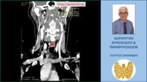 Απεικόνιση του αδενώματος στην 4D-CT - κατά μέτωπο διατομή (κόκκινο βέλος)
