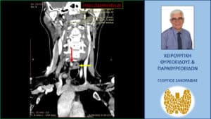 Απεικόνιση του αδενώματος (κόκκινο βέλος) σε κατά μέτωπο διατομή στην 4D-CT σε  διαφορετικό επίπεδο. Απεικονίζεται σε παρακείμενη θέση και ο οισοφάγος (κίτρινο βέλος)