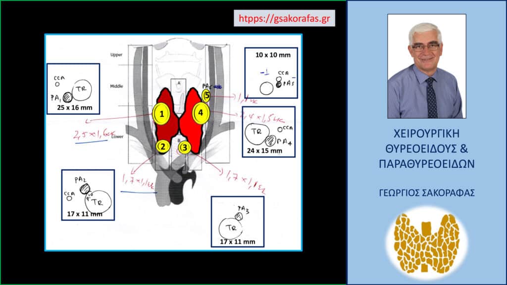 Home Τριτοπαθής υπερπαραθυρεοειδισμός - διάχυτη υπερπλασία 5 παραθυρεοειδών (ο ένας υπεράριθμος) σε ασθενή μας