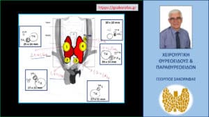 Τριτοπαθής υπερπαραθυρεοειδισμός  - διάχυτη υπερπλασία 5 παραθυρεοειδών (ο ένας υπεράριθμος) σε ασθενή μας
