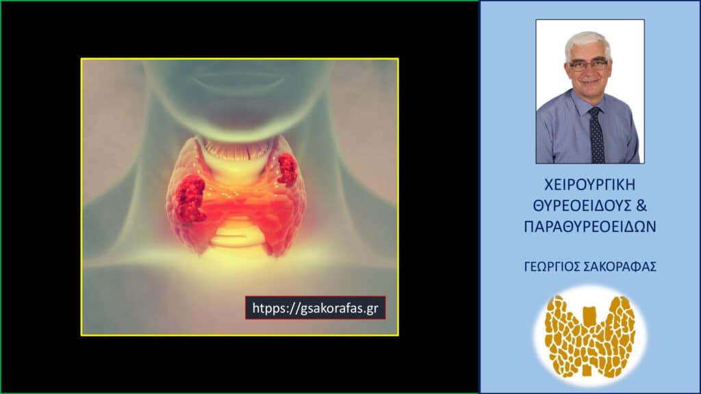 Home Θυλακιώδες νεόπλασμα θυρεοειδούς απροσδιόριστης βιολογικής συμπεριφοράς (FT-UBB, follicular tumor or uncertain biological behavior) – ποιος ο ρόλος της θεραπείας με ραδιενεργό ιώδιο?